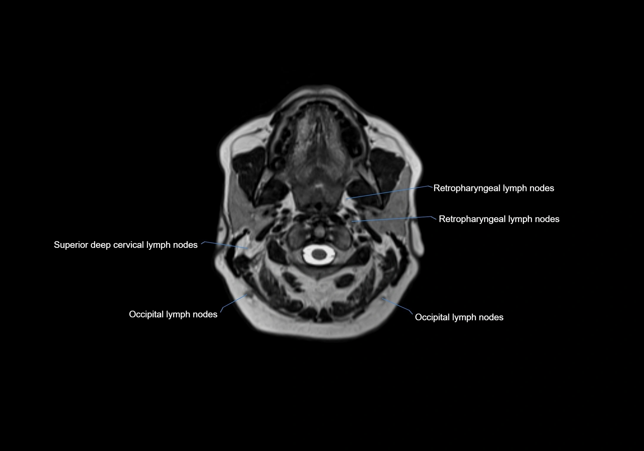Neck axial  lymph node cross sectional MRI anatomy 3T MRI  image-img-00001-00035.webp